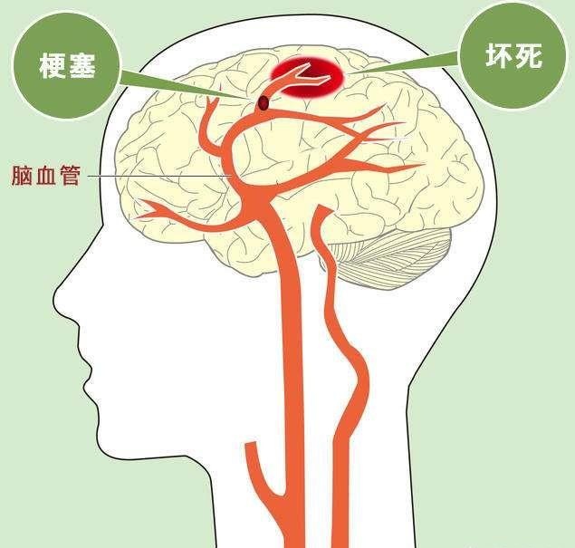 脑梗塞,脑血栓,脑出血都有什么区别?
