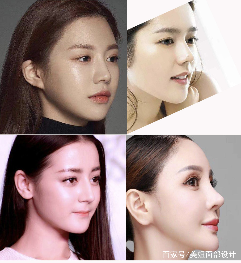 于朦胧整容后恢复得如何