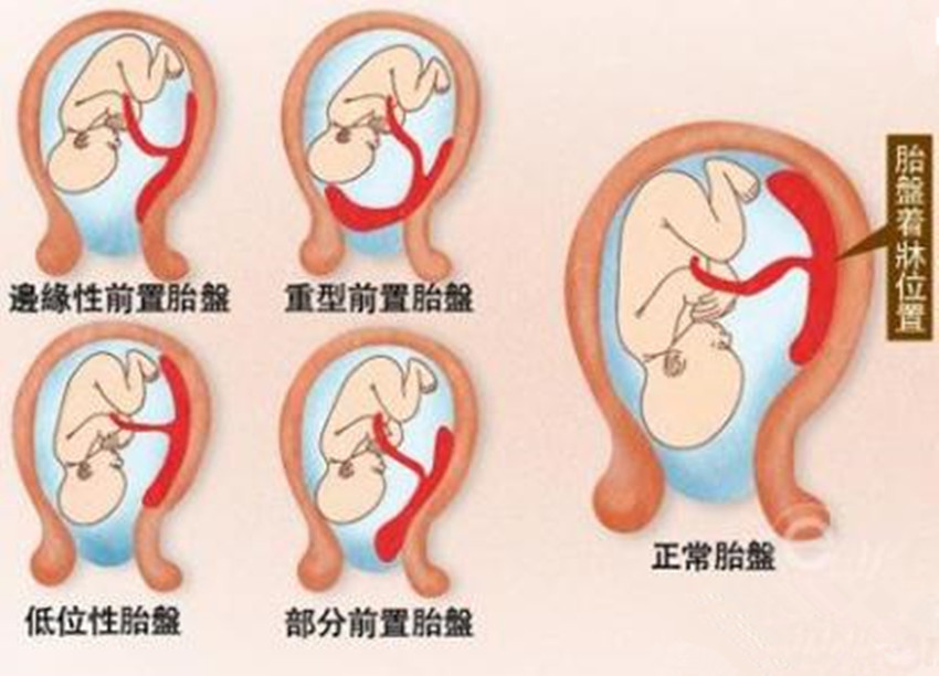 显示胎宝处于中央性前置胎盘,孕妈要重视