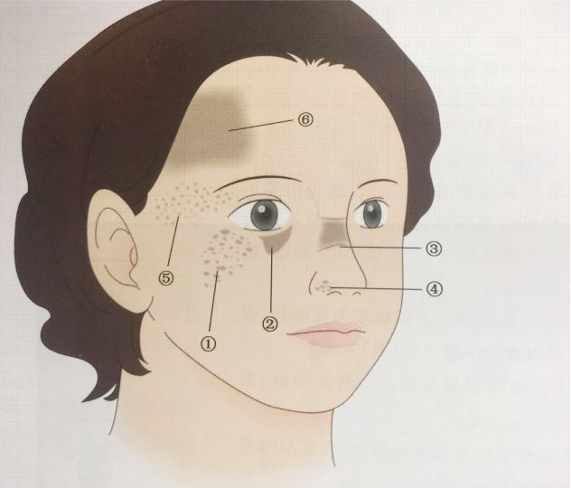 褐青色痣和黄褐斑的区别丨科普篇