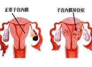 孕旅：为什么子宫内膜异位症导致不孕？有什么方法可以治愈呢？