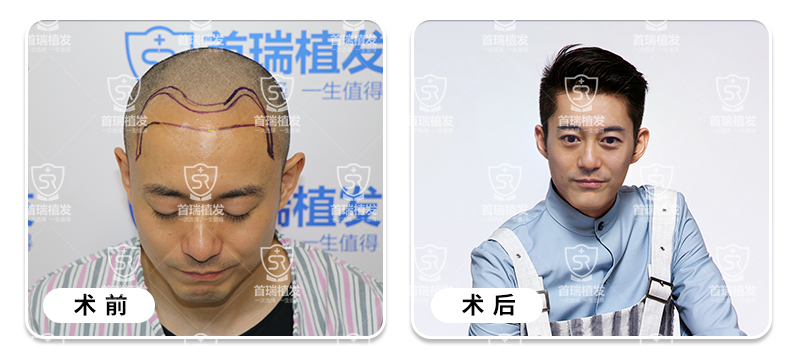百合脱发治疗,治好脂溢性脱发?花叶生姜病图片