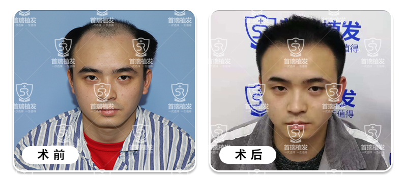 生姜治疗脱发,治好脂溢性脱发?别人叫皮皮虾我应该叫什么图片