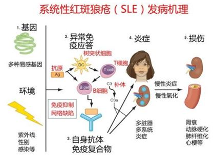 干细胞治疗系统性红斑狼疮