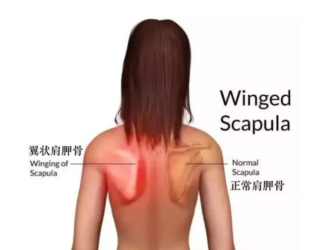 漂亮的叫蝴蝶骨,丑叫翼状肩