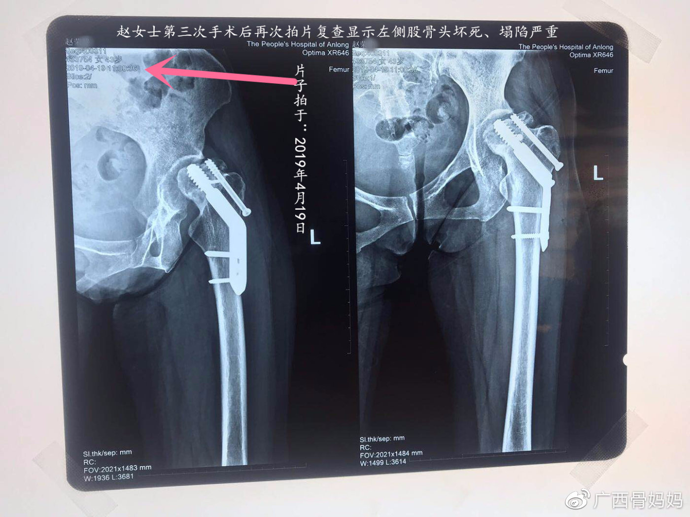 贵州女士股骨颈骨折手术耗资数十万元 两年不到重度股骨头坏死