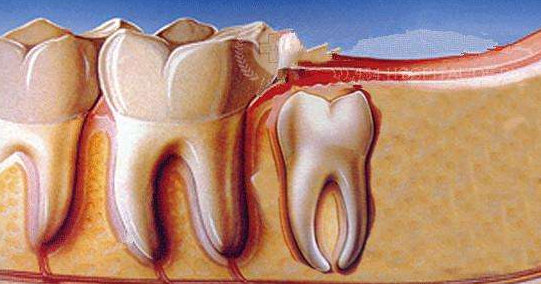 告诉你:牙齿经常发炎?可能是智齿在作怪!