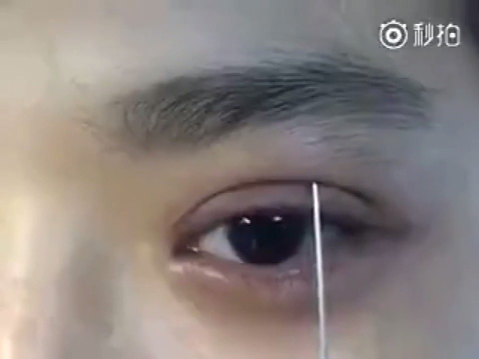 单眼皮想知道自己做双眼皮后好不好看,可以在家用牙签