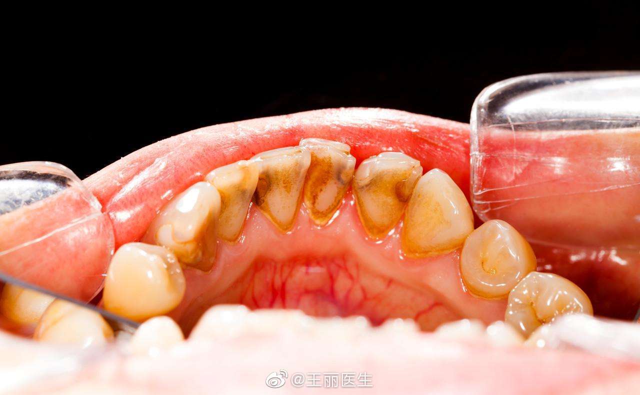牙齿表面黄色的软垢是什么？怎么清理效果最佳？专家给出办法 - 知乎