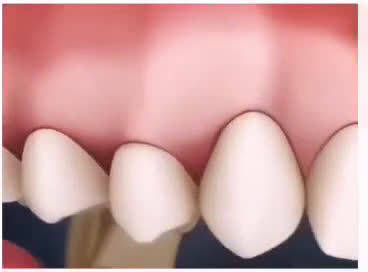为什么要洗牙呢，来看看不定期洗牙的危害！