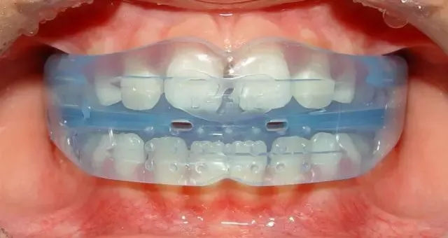 苏州王先军主任：无托槽隐形矫治器有哪些注意事项