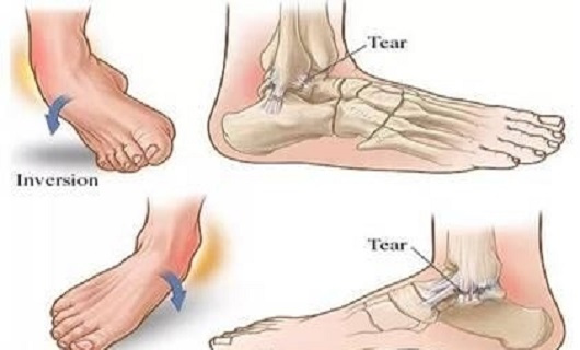 踝关节扭伤后关节活动度的训练