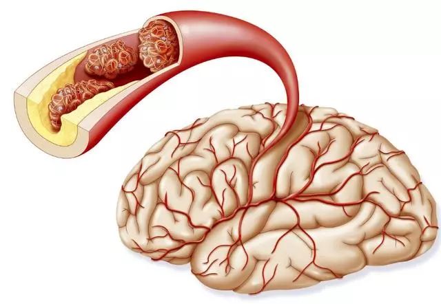 23岁女孩,突发脑梗,查出病因后,女孩捂脸痛哭: