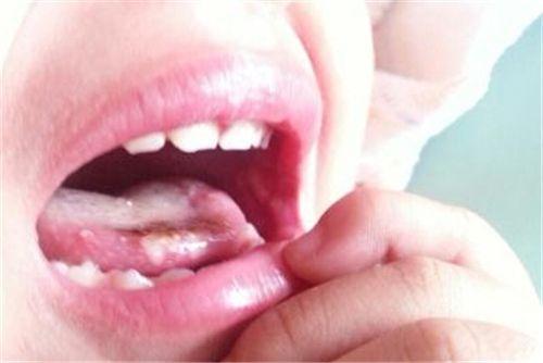 老年人口腔溃疡的原因_口腔溃疡图片