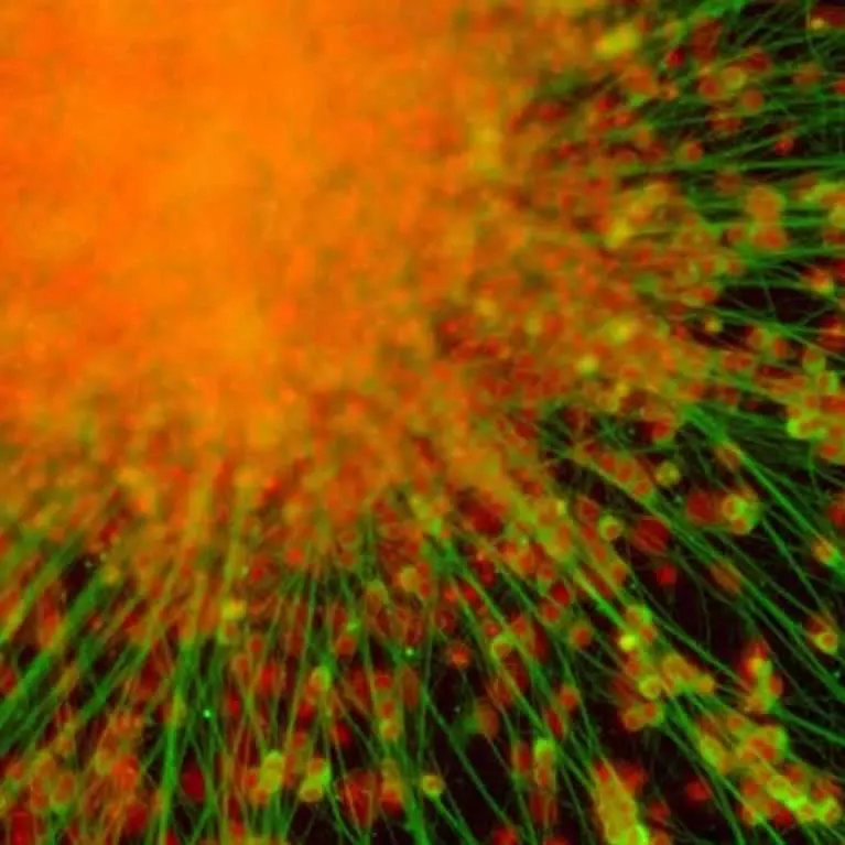 躁郁症患者老得更快，并且他们的大脑可能发炎了