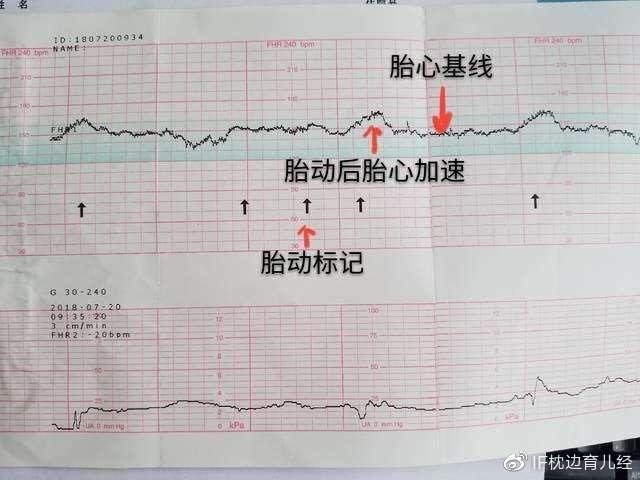 胎心监护时胎儿不动怎么办?做胎监注意事项,以及过来人经验分享