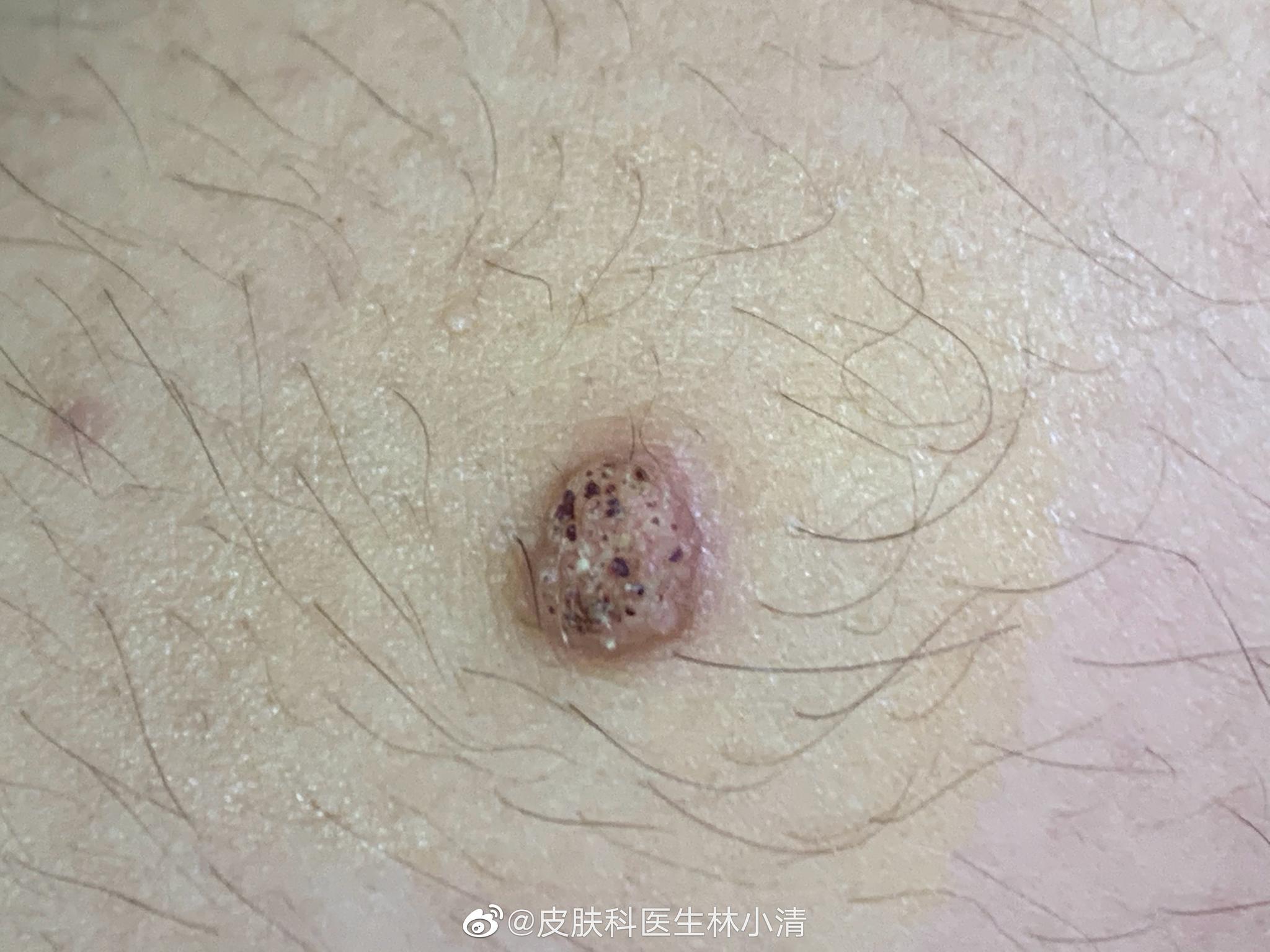 两只不同部位的瘊子(寻常疣),这两只瘊子不吃香蕉