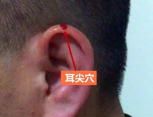 刺血疗法治疗高血压 中医刺血疗法究竟有没有用