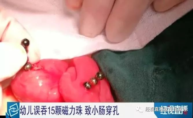 提醒！还有家长给孩子买这种球，湖北一幼儿被它害得肠穿孔！