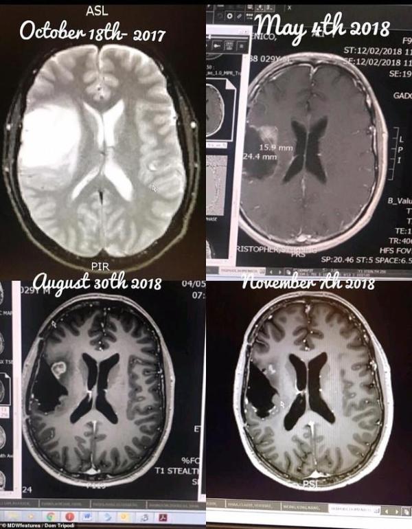 澳洲男子患晚期脑癌活不到一年,放弃化疗改吃素食竟成功治愈癌症