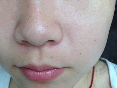 柏翠丝鼻贴怎么用？