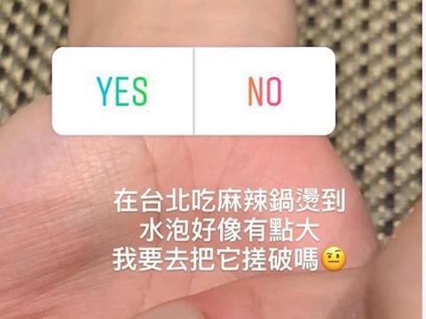 吃货无疑！何超莲吃路边摊把手烫出了水泡，网友：窦骁吹吹就好了