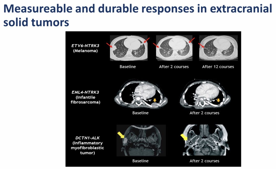 ASCO重磅丨Entrectinib治疗携带NTRK1/2/3、ROS1和ALK基因变异的儿科实体肿瘤，效果喜人
