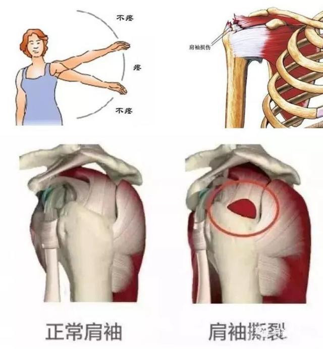 正文          肩袖损伤示意图   保守治疗的话,既然是肩袖轻度磨损