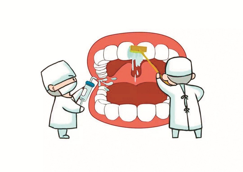 洗牙能洗掉牙菌斑吗?