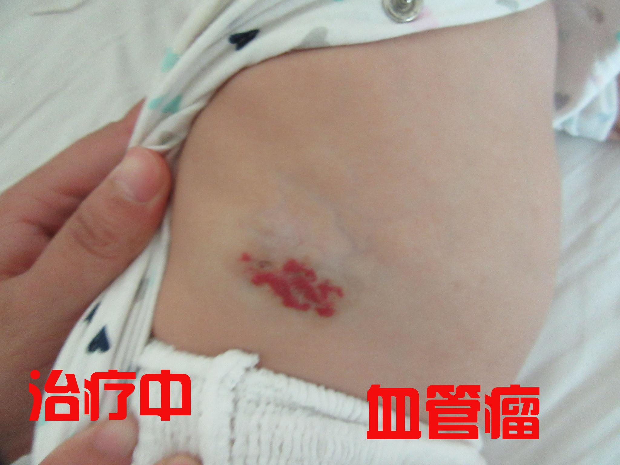 婴儿血管瘤什么时候治疗最好?这时期治疗对宝宝最好