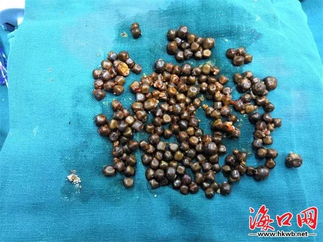 惊呆了6旬男子取出207颗胆囊结石专家提醒要按时吃早餐