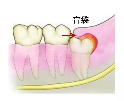 某明星拔完智齿脸竟变成了这样到底该不该拔今天和你说清楚