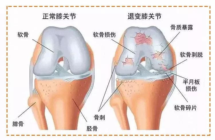 慢跑or快走哪个对身体好？利弊都在这了，选错很伤膝盖！