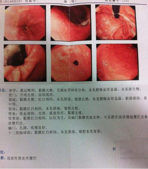 我曾经是一个胃病患者,糜烂性胃炎伴胆汁反流,导致我只要站着就感觉