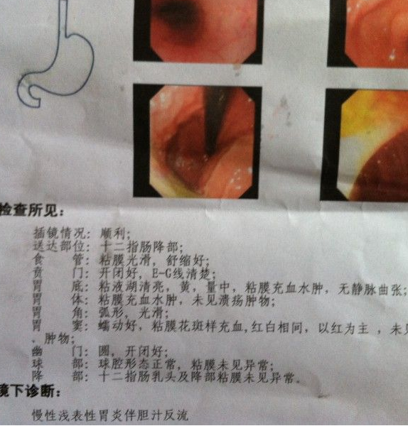 检查,想了解自己到底是怎么了,最后结果医生说我患上的是浅表性胃炎