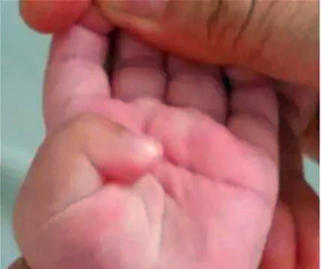 宝宝拇指内扣,妈妈要上心,婴儿握拳反射和拇指内扣的主要区别