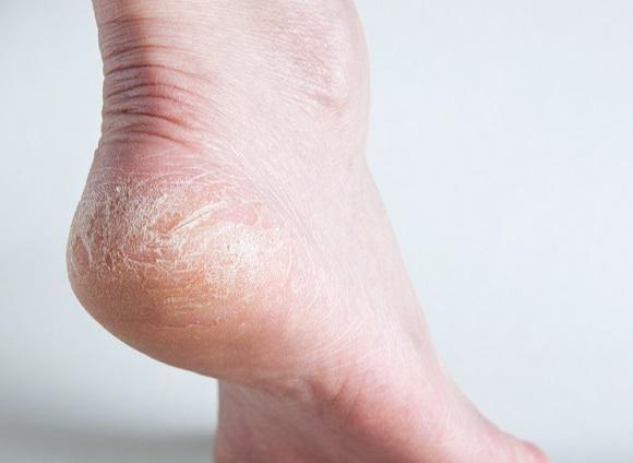 糖尿病不是突然发生的,脚部出现3个症状,可能