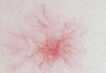 辟谣:皮肤长红痣,蜘蛛痣,就是肝病标志吗?其实很多人没弄清楚