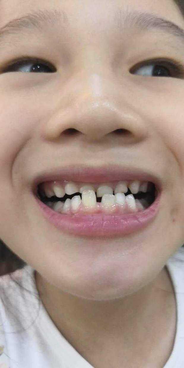 什么叫"六龄磨牙"?换牙期做到这4点,孩子恒牙顺利长出