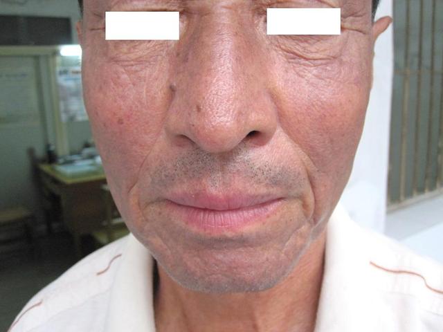 肝病先上脸出现这种肝病面容抓紧就医肝硬化可能已经发生