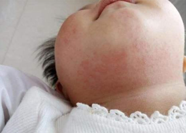 这七大常见的皮肤问题处理方法,可要收好|宝宝|皮肤病|乳痂_新浪新闻
