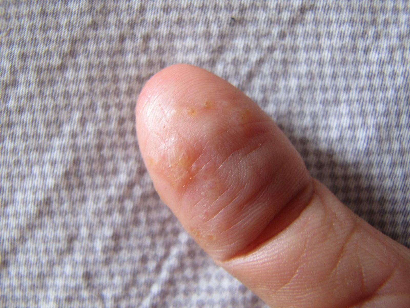 一个患水痘的孩子的手在她母亲的手里。手上有水痘的水泡。照片摄影图片_ID:350793496-Veer图库