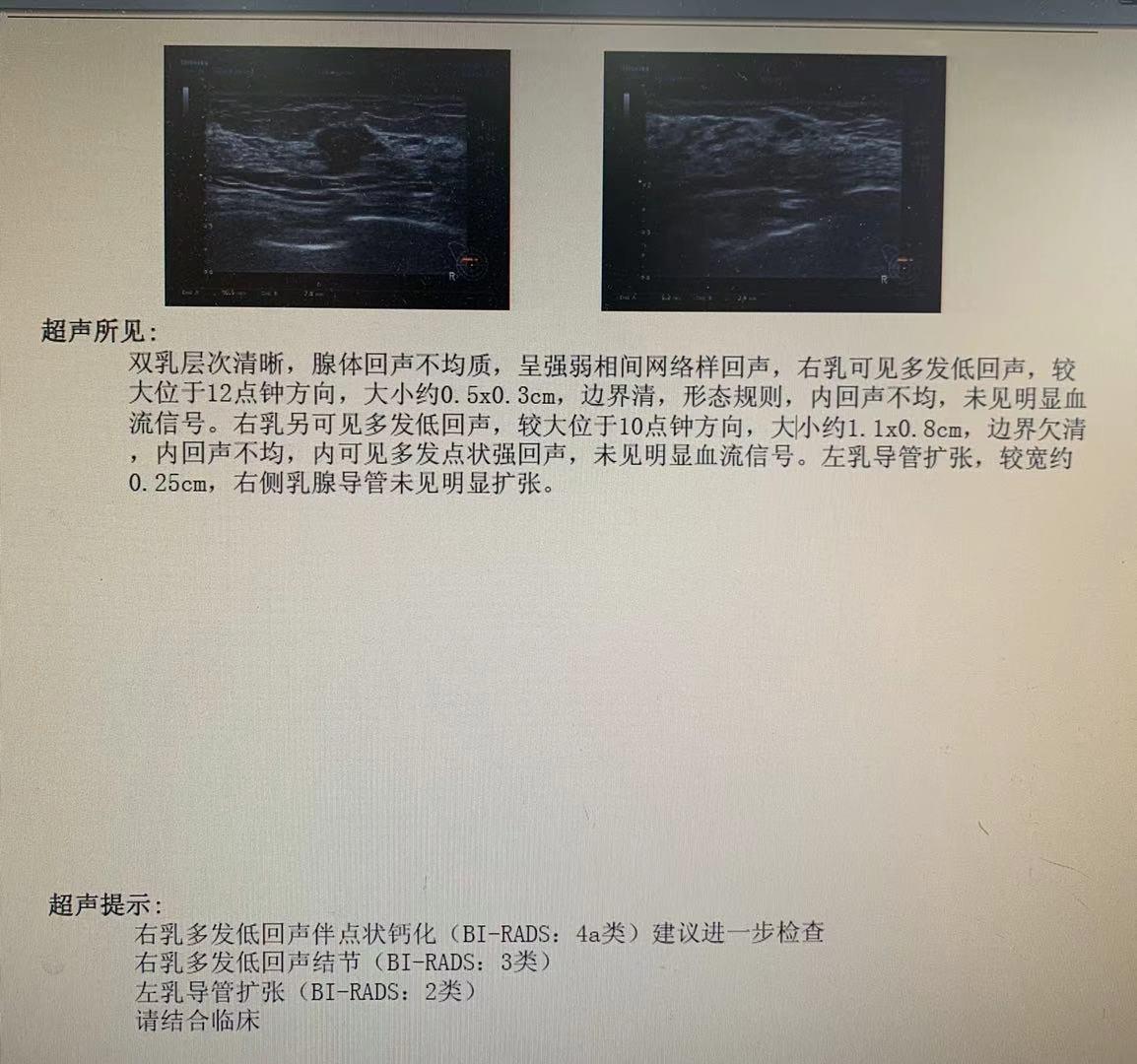 乳腺结节,吃药可以治好?幸亏医生多看了一眼检查,救了