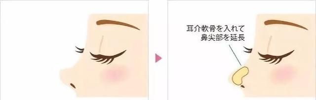 已经长得很好看了，为什么还要去整鼻子？