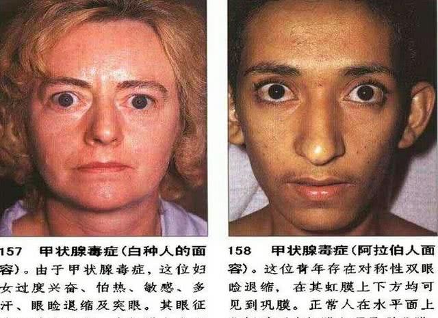 如何通过合理饮食抗“甲亢”?...