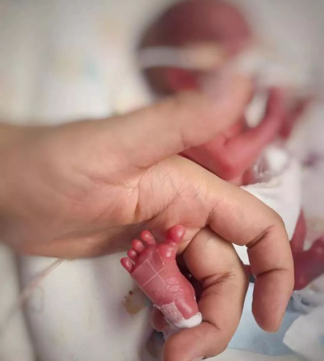 极早产婴儿出生仅29厘米,体重580克,在保温箱住140天后出院