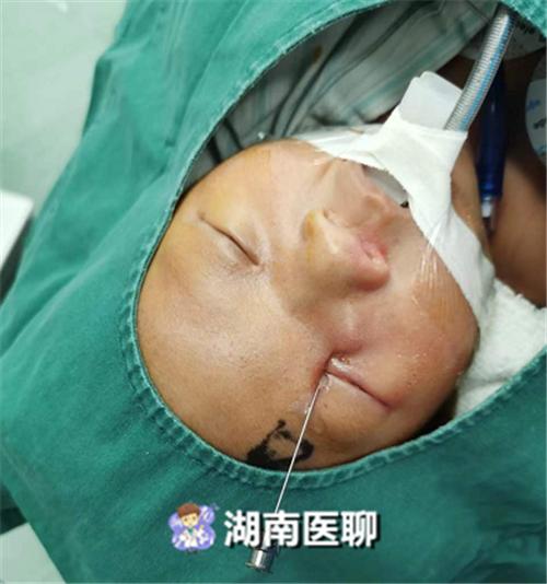 痛心!18天宝宝先天泪道阻塞,一家五口千里求医