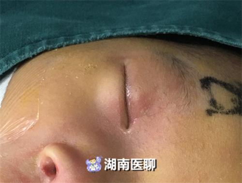 痛心!18天宝宝先天泪道阻塞,一家五口千里求医