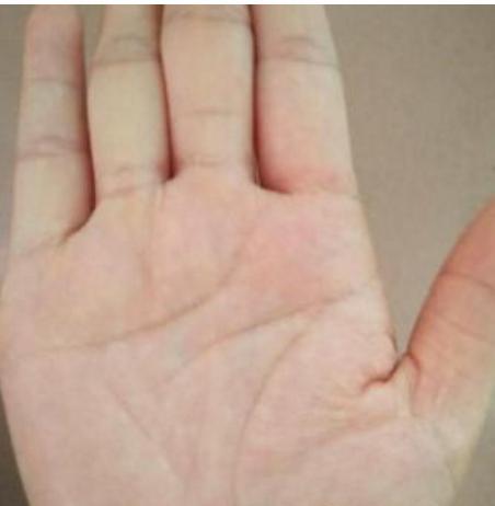 手腕线断裂警报!深入分析HPV疫苗接种人群及潜在风险
