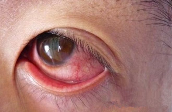 眼睛中的红血丝从何而来?医生:一般暗示3大疾病,不一定是熬夜
